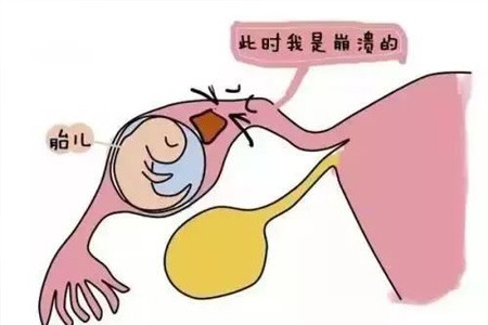 宫外孕是什么因素导致的(图1)