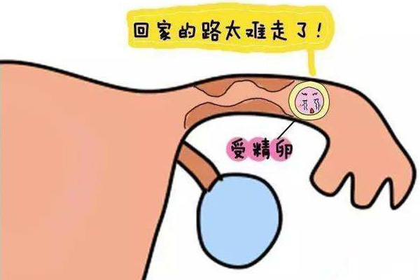 女性哪些情况容易造成宫外孕(图1)