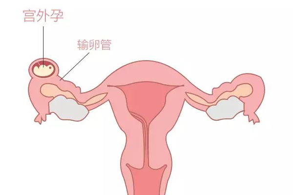 宫外孕的危害有哪些(图1)