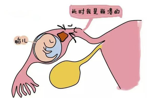 什么情况容易引发宫外孕(图1)
