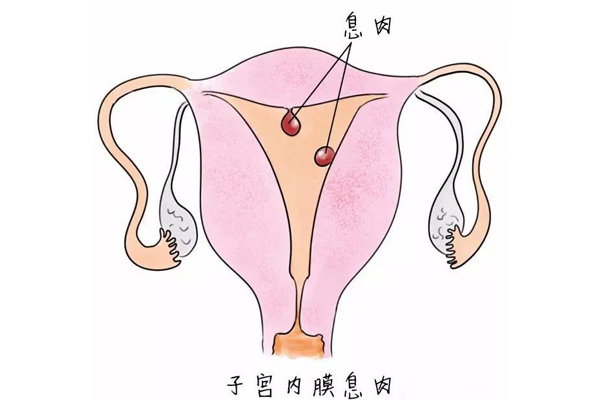 宫颈息肉的危害有哪些(图1)